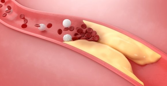 Visa tiesa apie cholesterolį: ko imtis, kad jis netaptų mūsų sveikatos priešu?